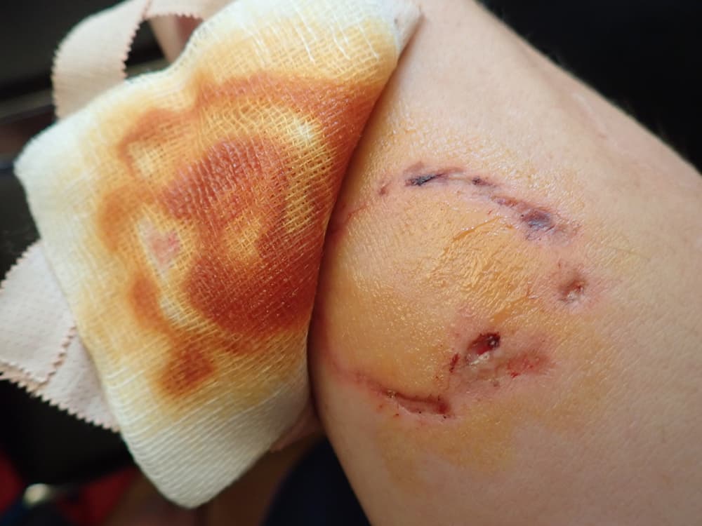 What are Some Common Dog Bite Injuries